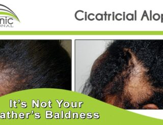 Cicatricial Alopecia