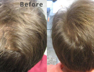 Restore hair